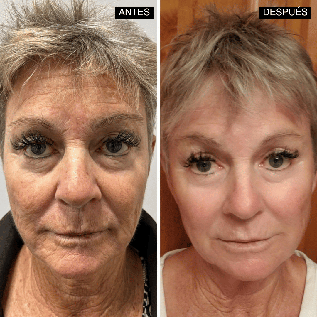 Velisse® Retinal Shot - Adiós Arrugas