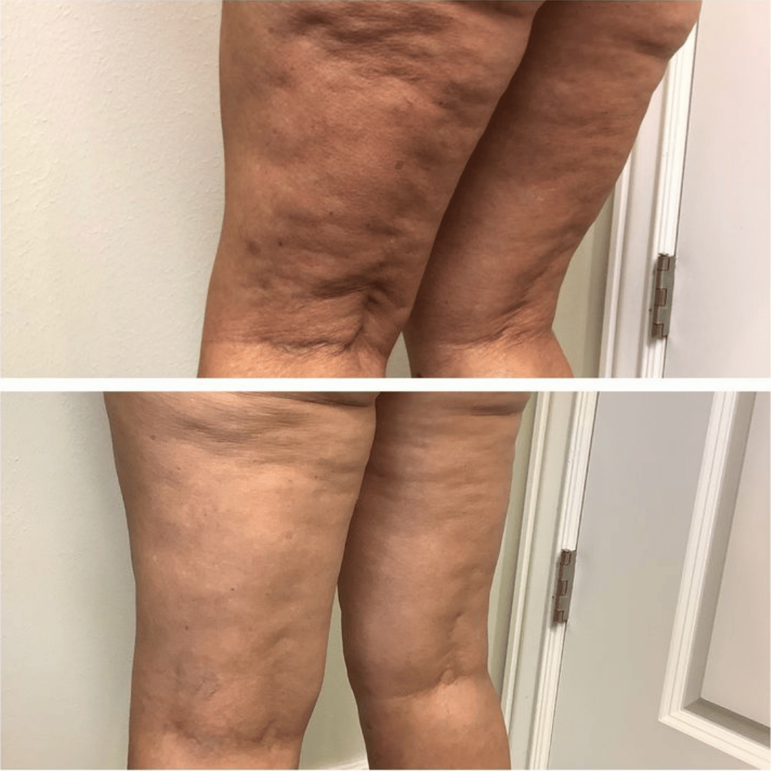 Velisse® Aceite Anti-Celulitis de Colágeno Hidrolizado