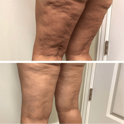 Velisse® Aceite Anti-Celulitis de Colágeno Hidrolizado