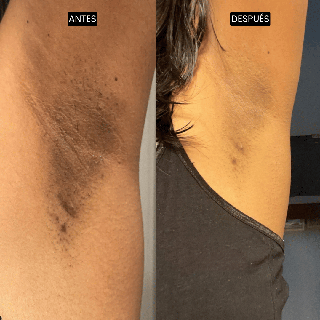 Velisse Piel Perfecta Shot - Spray exfoliante corporal con kójico y cúrcuma