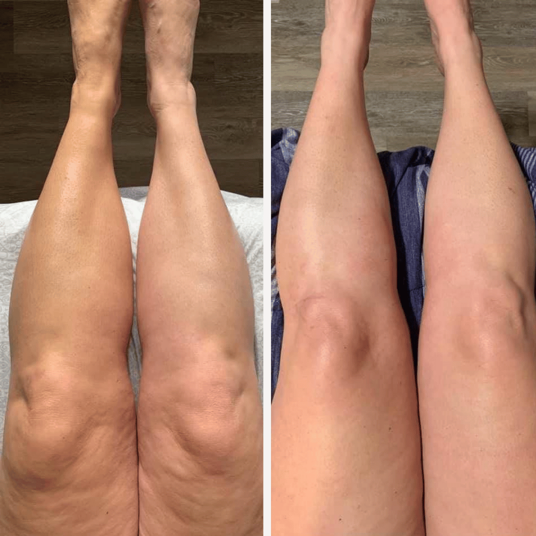 Velisse® Aceite Anti-Celulitis de Colágeno Hidrolizado